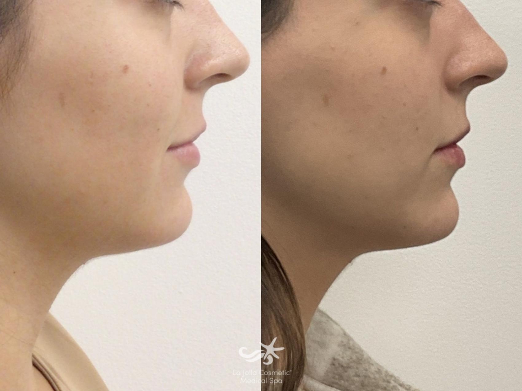 Before & After Restylane® Defyne Result 1053 Right Side View in San Diego, Carlsbad, CA