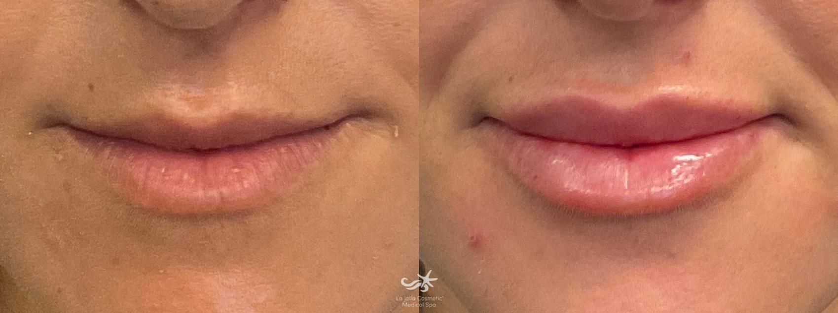 Before & After Restylane® Defyne Result 638 Front View in San Diego, Carlsbad, CA