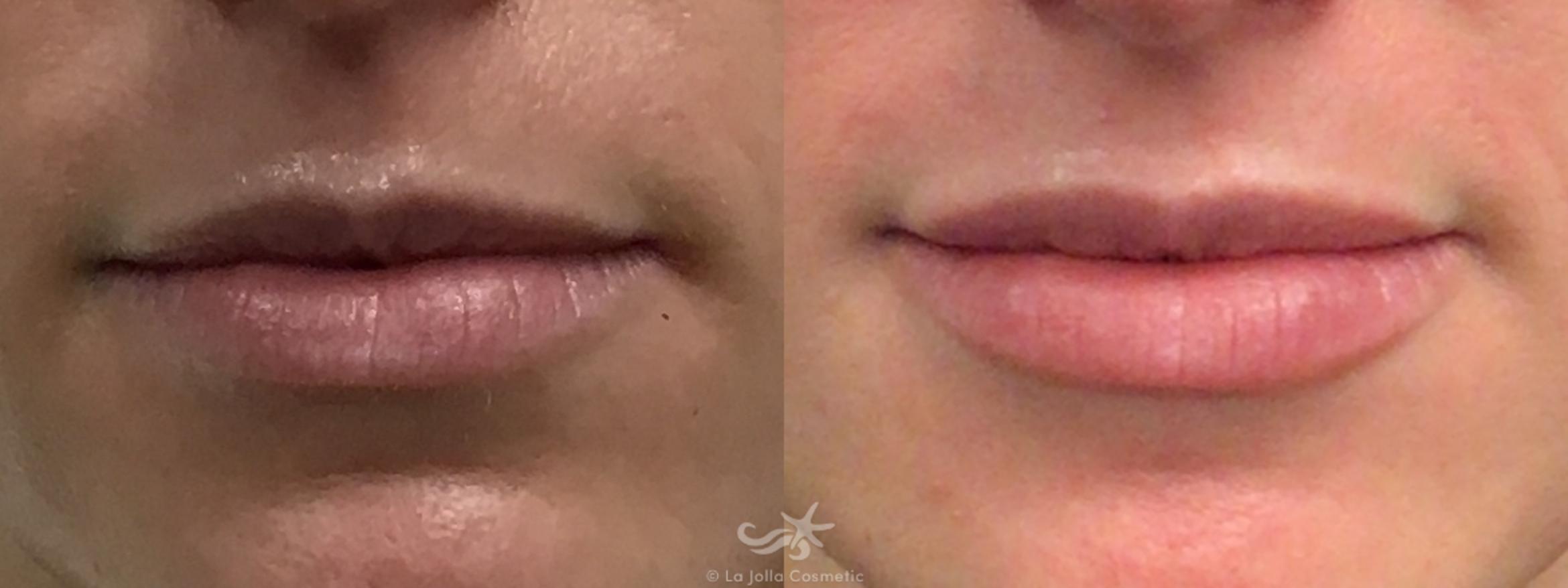 Before & After Restylane® Defyne Result 660 Front View in San Diego, Carlsbad, CA