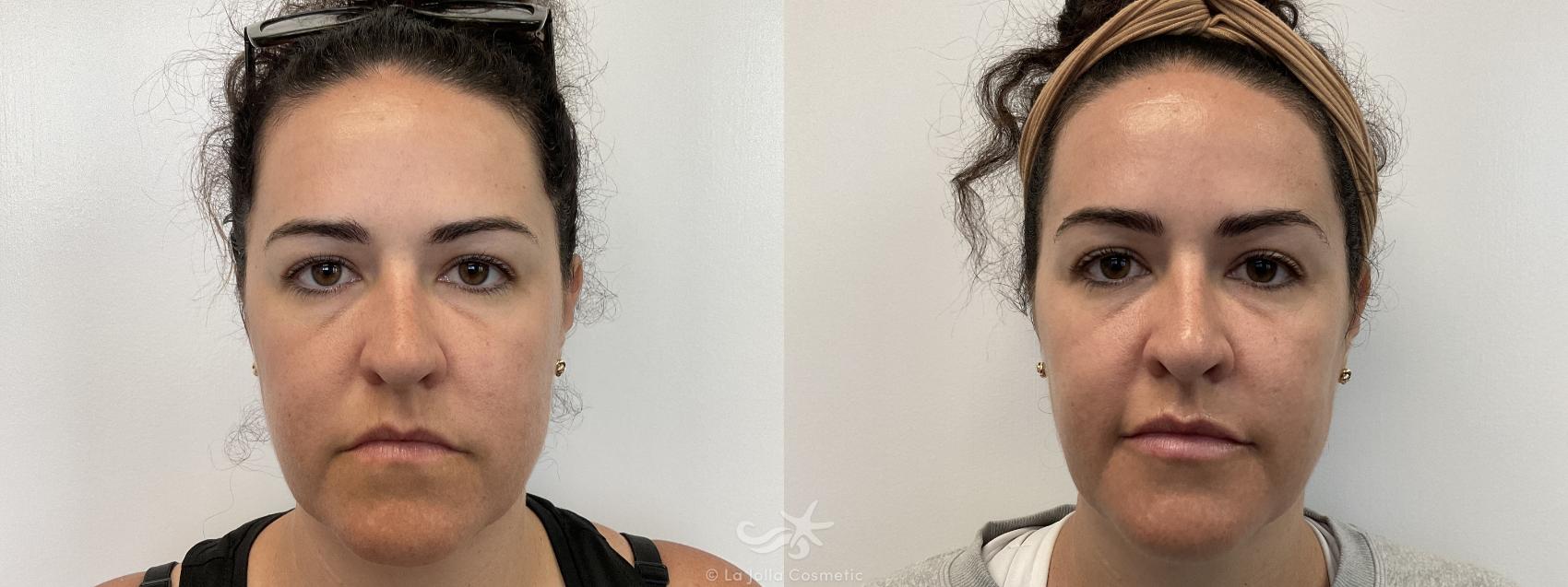 Before & After Sculptra® Result 985 Front View in San Diego, Carlsbad, CA