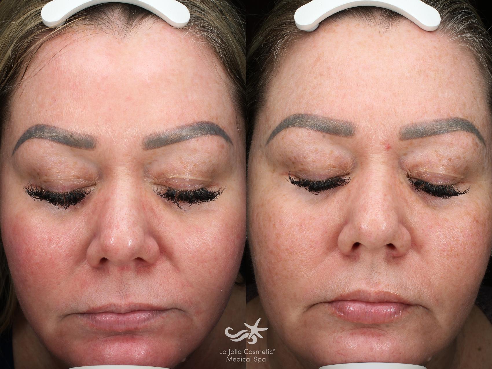 Before & After VBeam Laser Result 931 Front View in San Diego, Carlsbad, CA
